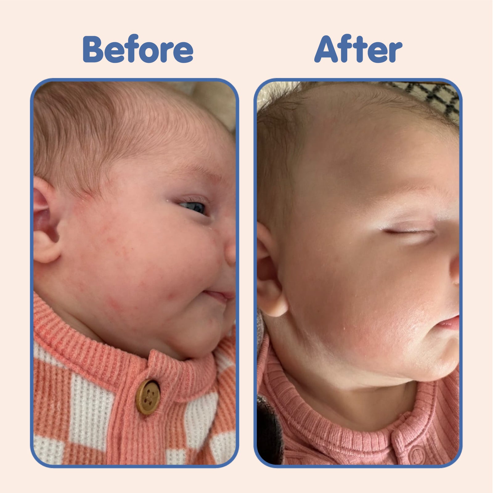 Before and after comparison of a baby’s cheek, showing skin improvement. On the left, the 'Before' image shows red, irritated skin with small bumps. On the right, the 'After' image shows smoother, calmer skin. Blue text labels indicate 'Before' and 'After' to highlight the transformation